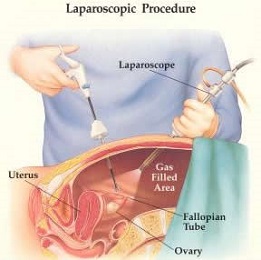 faq laparoscopy