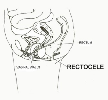 rectocele1.jpg