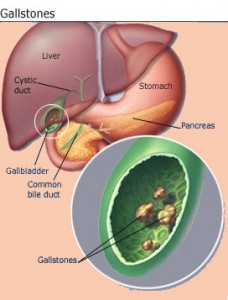 Gall Stones