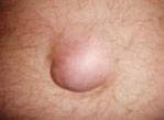 Hernia