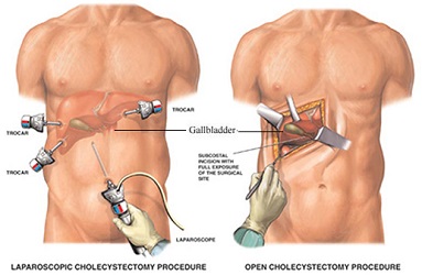 laproscopic-gall-bladder