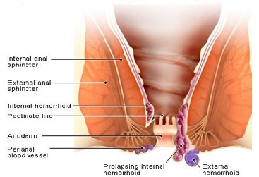 hemorrhoid1.jpg