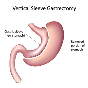 Sleeve Gastrectomy