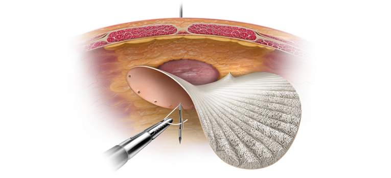 how-is-the-use-of-mesh-helpful-during-a-hernia-surgery-neoalta