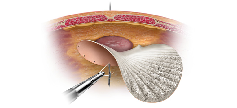 Surgical Mesh Used for Hernia Repair