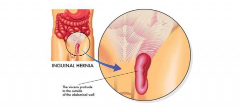 Hernia Surgery, Hernia Repair