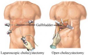 laproscopic-gall-bladder