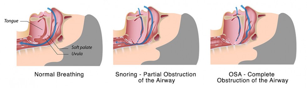 Complications Of Sleep Apnea Surgery