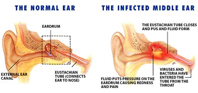 Ear Infection And Antibiotic In Children