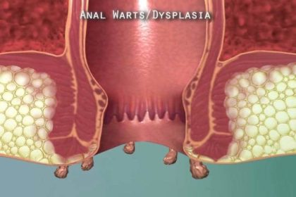 Treatment Anal Warts